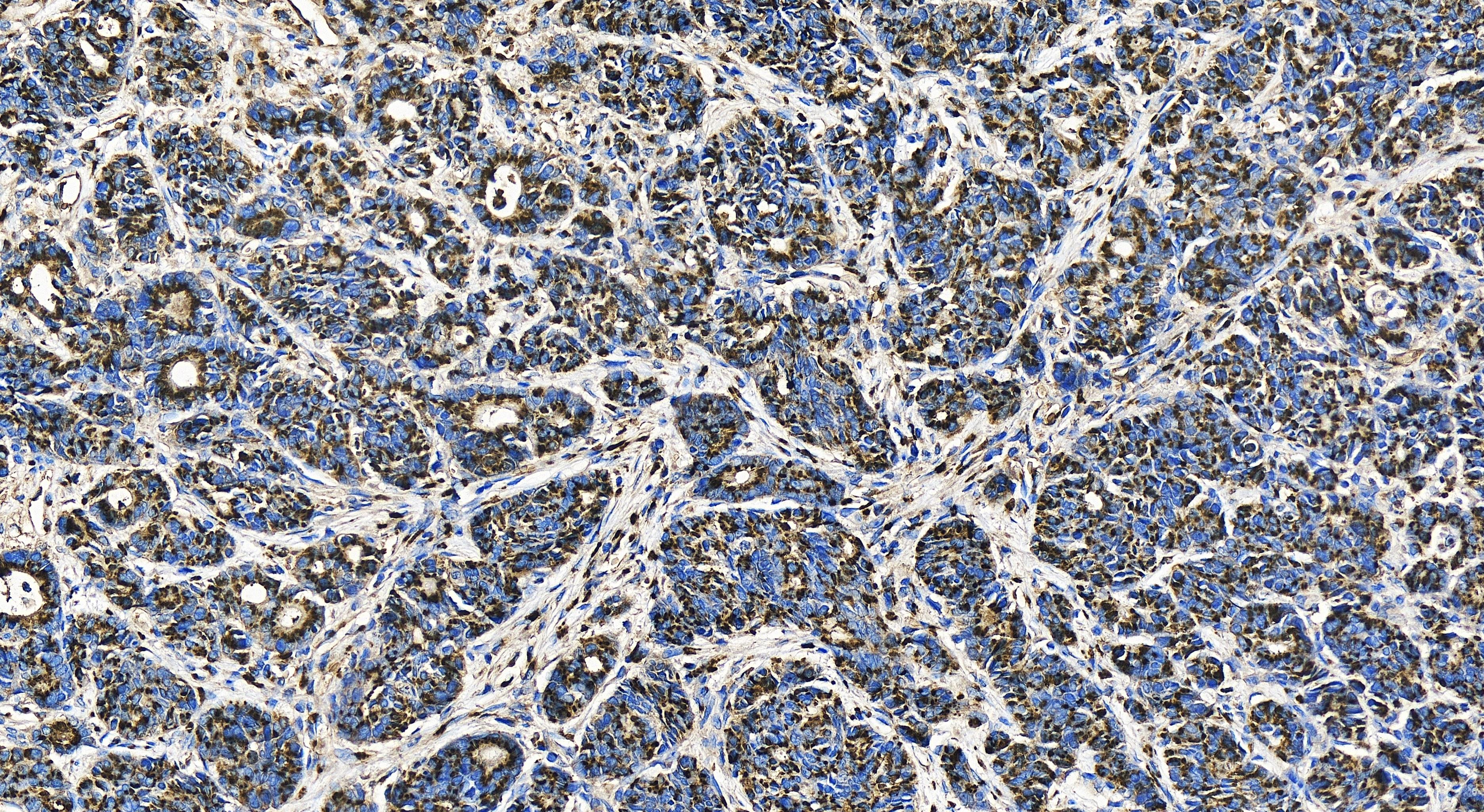 IHC staining of human stomach cancer using 81893-1-RR