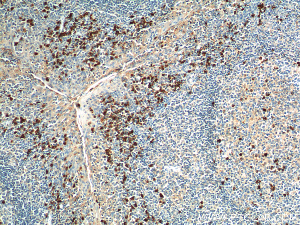 IHC staining of human tonsillitis using 20307-1-AP