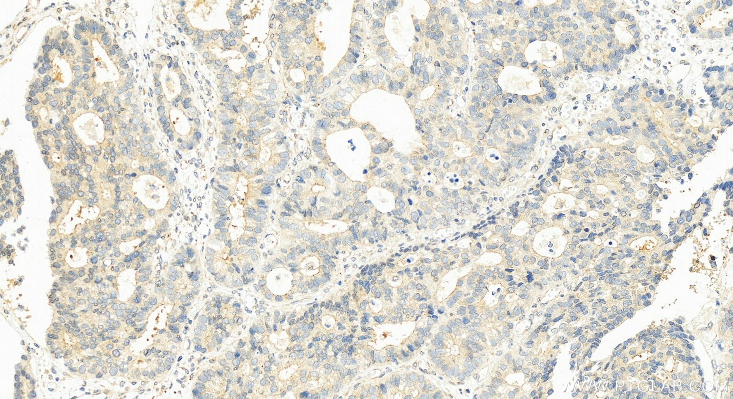 IHC staining of human stomach cancer using 55248-1-AP