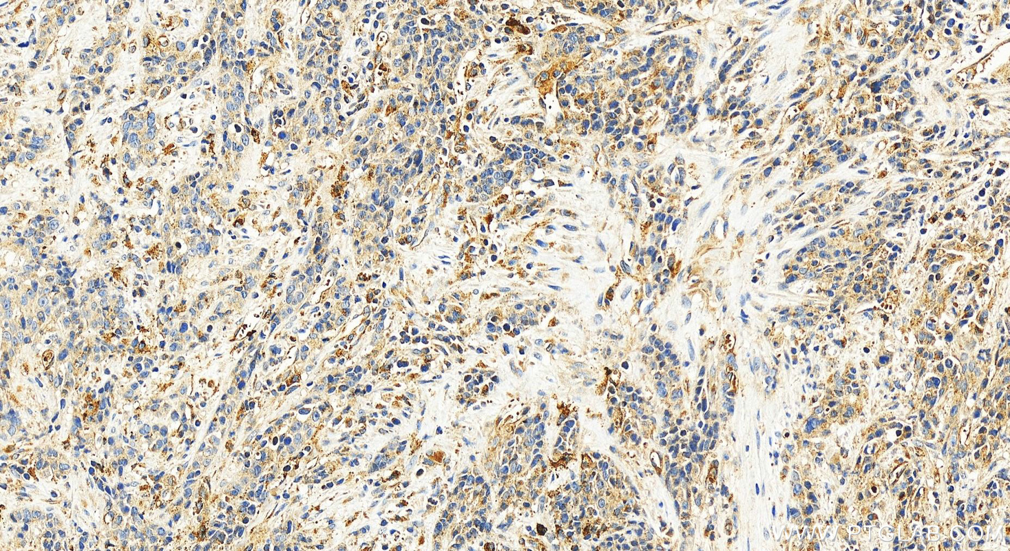 IHC staining of human stomach cancer using 55248-1-AP