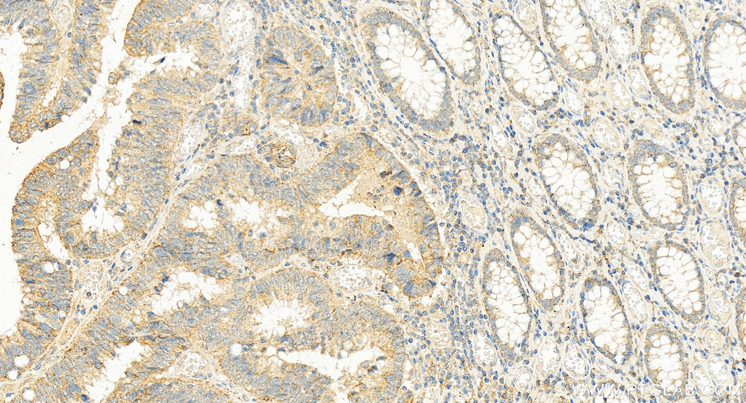 IHC staining of human colon cancer using 10309-1-AP