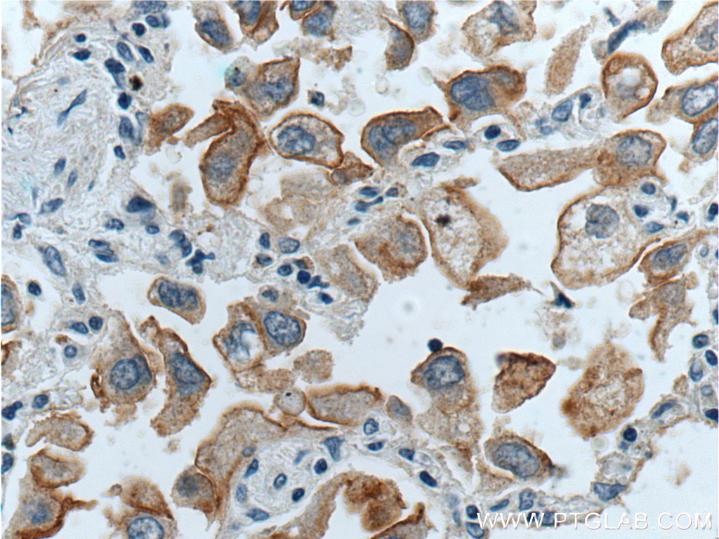 IHC staining of human lung cancer using 10309-1-AP