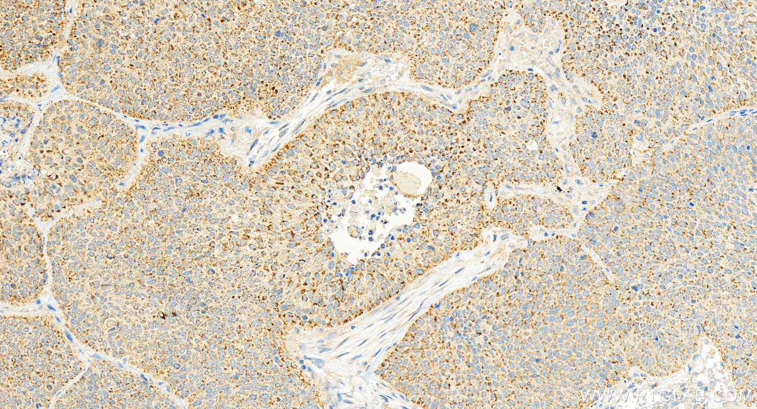 IHC staining of human lung squamous cell carcinoma using 10309-1-AP