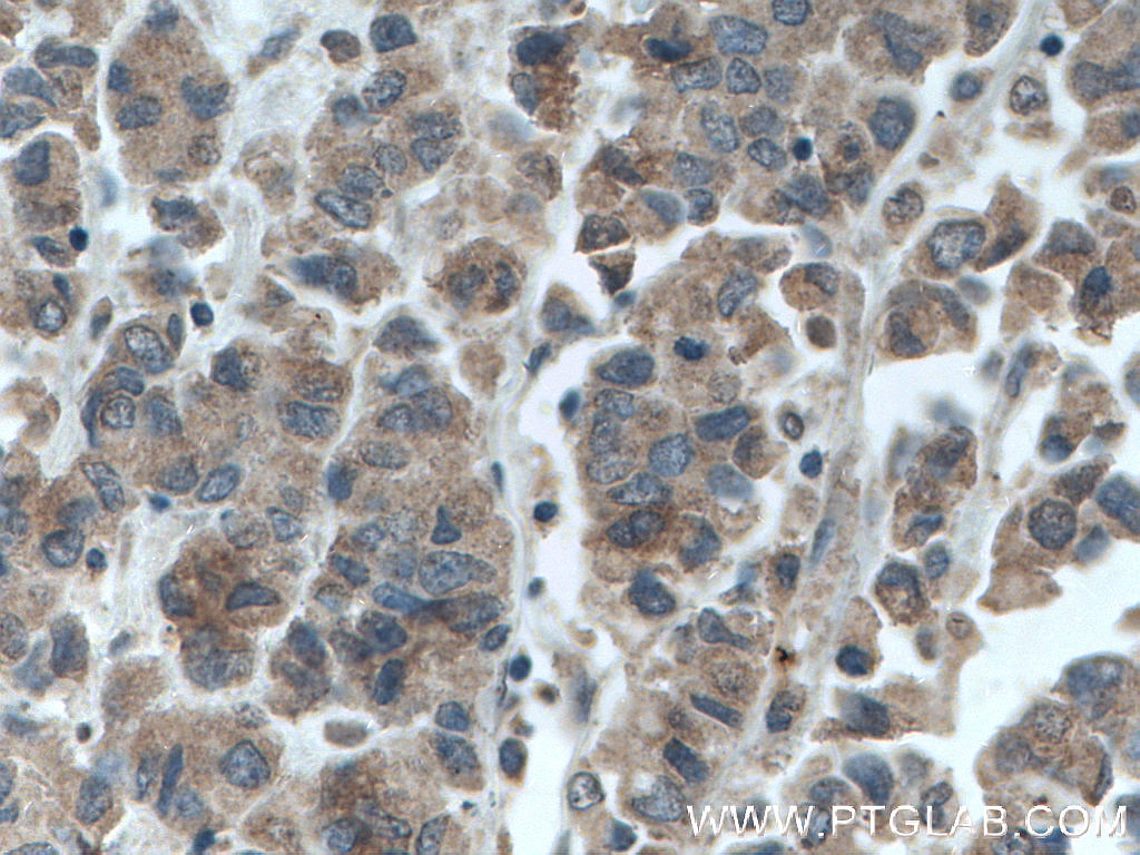 IHC staining of human prostate cancer using 66651-1-Ig (same clone as 66651-1-PBS)