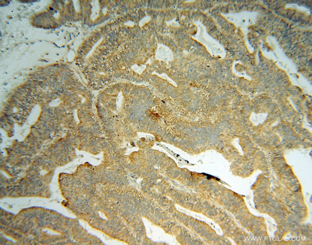 IHC staining of human ovary tumor using 15298-1-AP