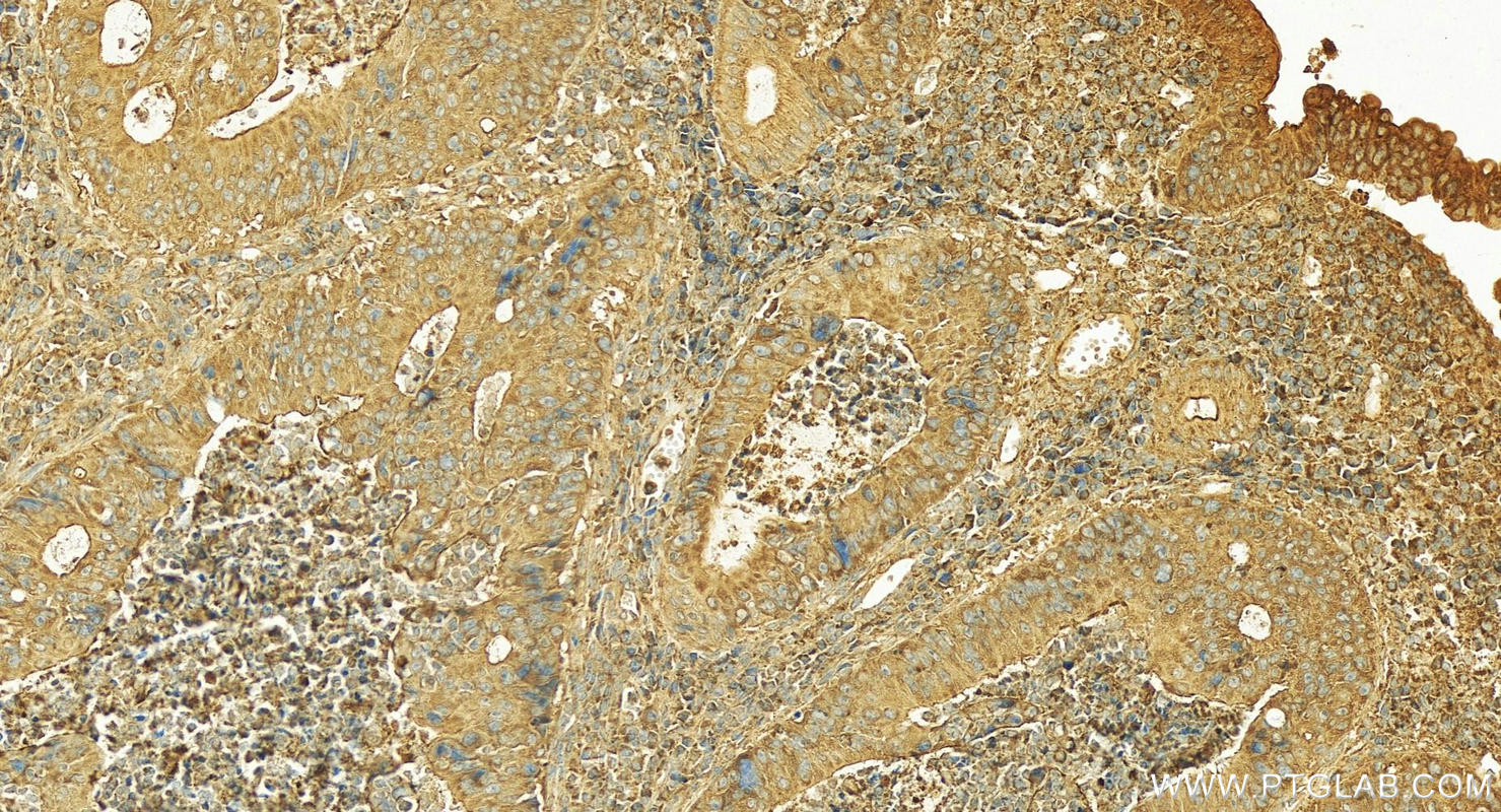 IHC staining of Human colon cancer using 18224-1-AP