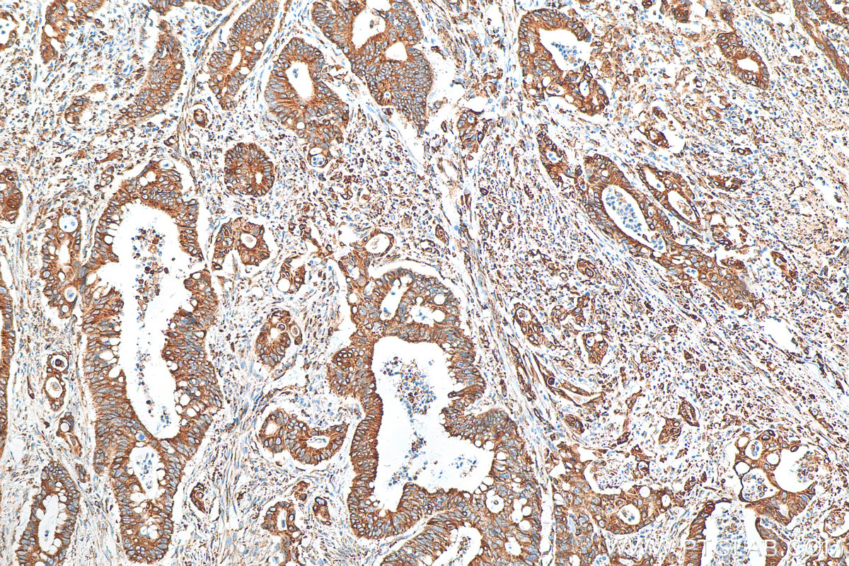 IHC staining of human colon cancer using 80849-1-RR (same clone as 80849-1-PBS)