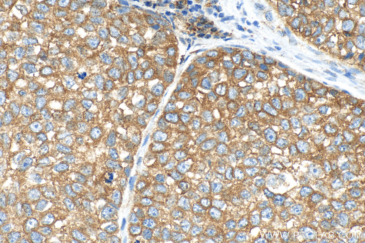 IHC staining of human breast cancer using 82805-2-RR (same clone as 82805-2-PBS)