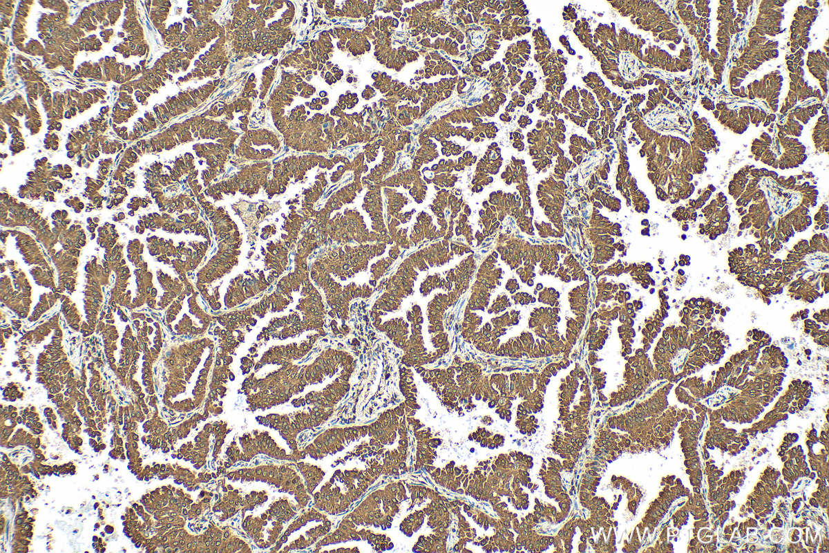 IHC staining of human lung cancer using 83147-5-RR