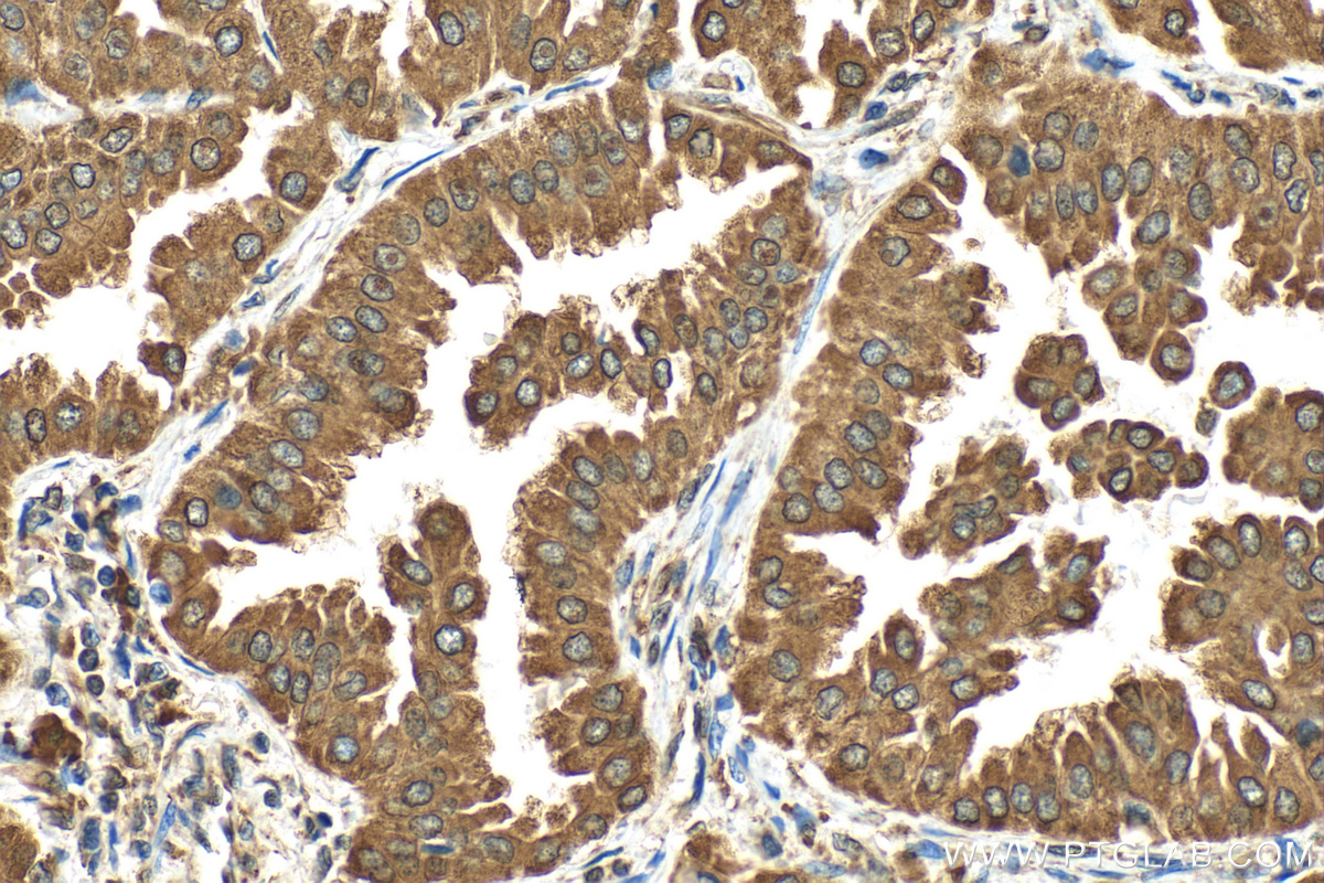 IHC staining of human lung cancer using 83147-5-RR