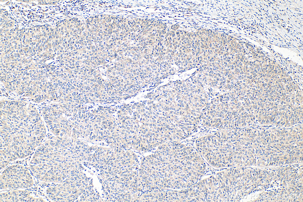 IHC staining of human cervical cancer using 14163-1-AP