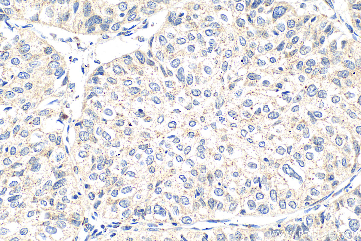 IHC staining of human cervical cancer using 14163-1-AP