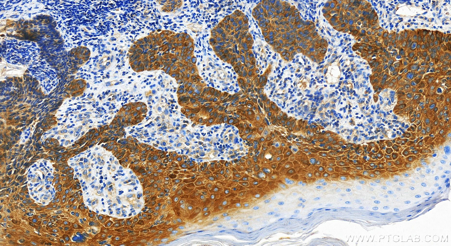 IHC staining of Human bowens disease using 30469-1-AP