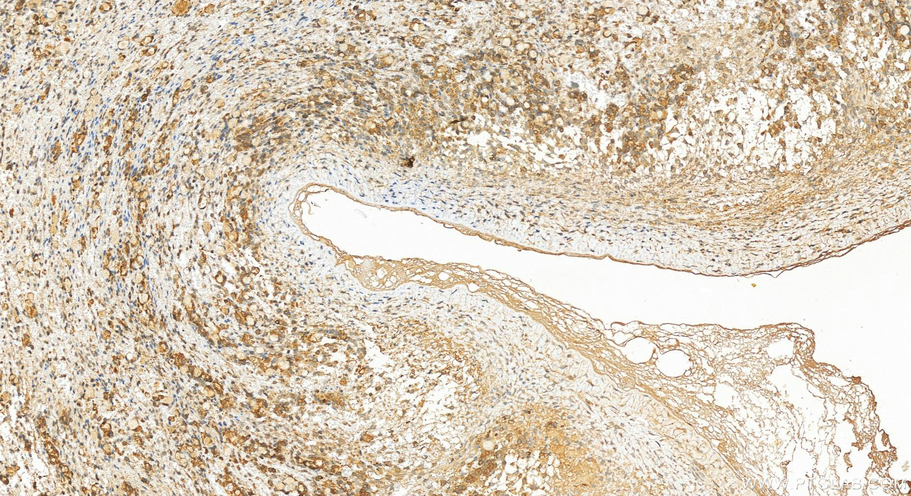 IHC staining of human ovary cancer using 20770-1-AP