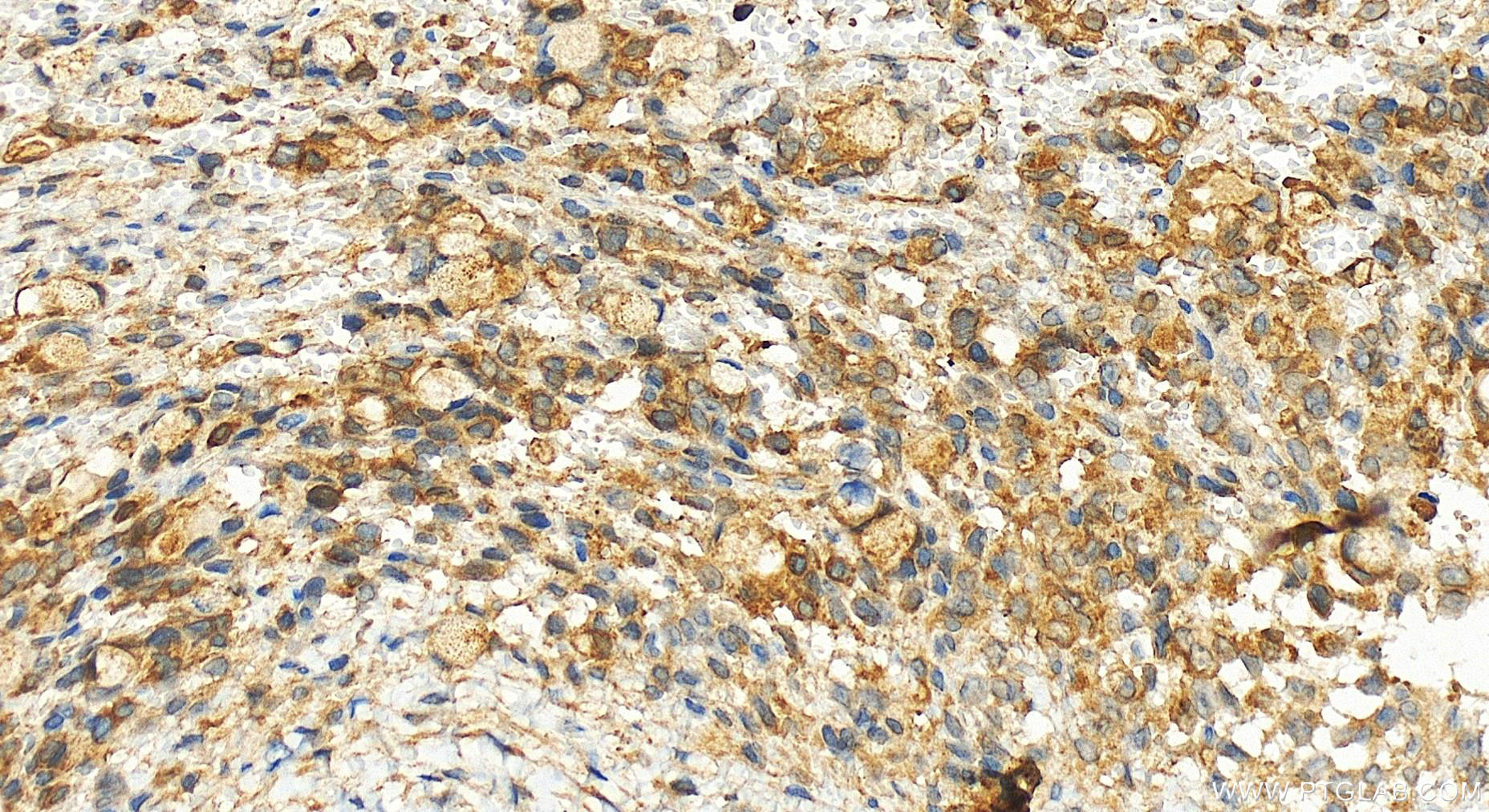 IHC staining of human ovary cancer using 20770-1-AP