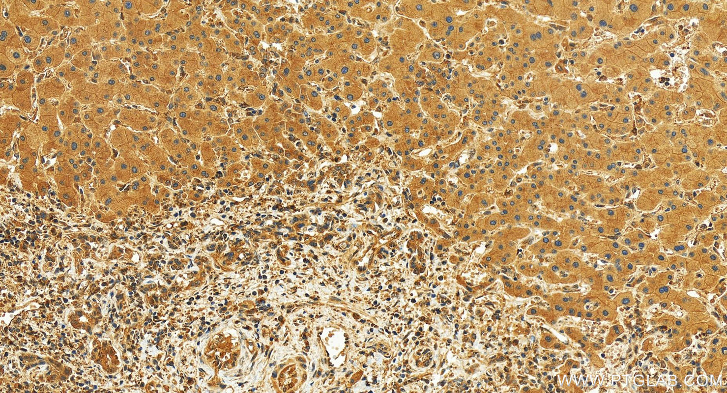 IHC staining of human intrahepatic cholangiocarcinoma using 30531-1-AP