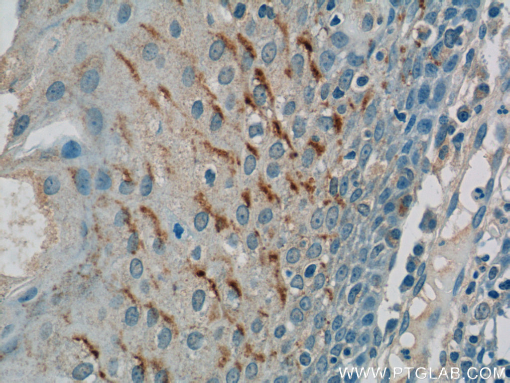 IHC staining of human tonsillitis using 17328-1-AP