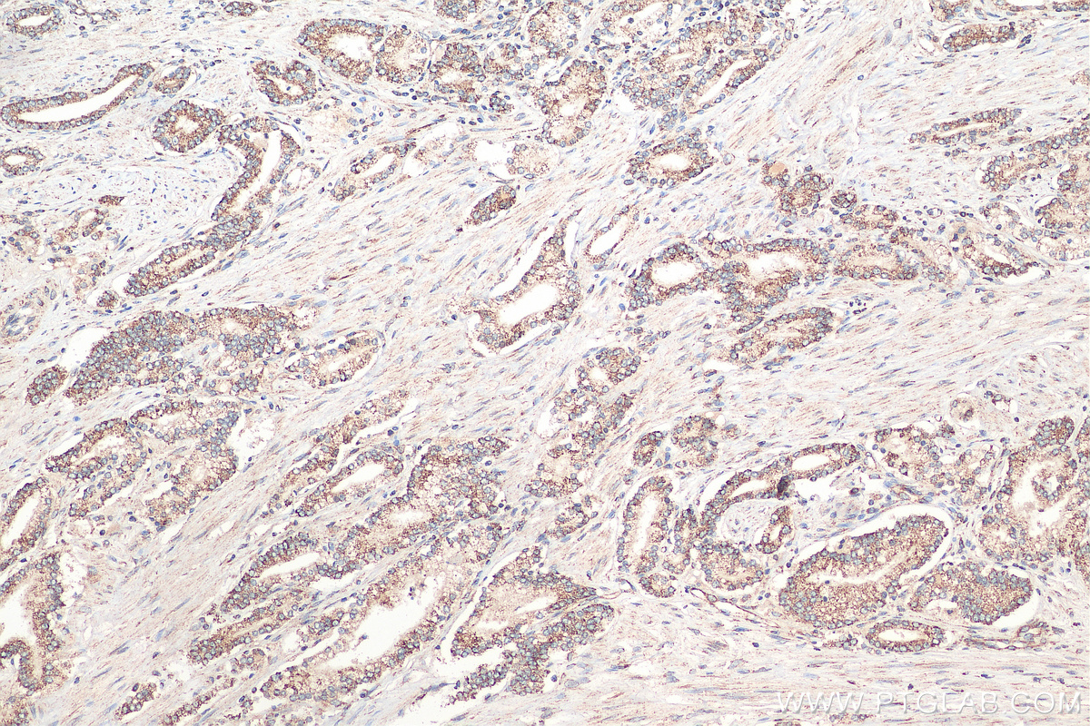 IHC staining of human prostate cancer using 13419-1-AP