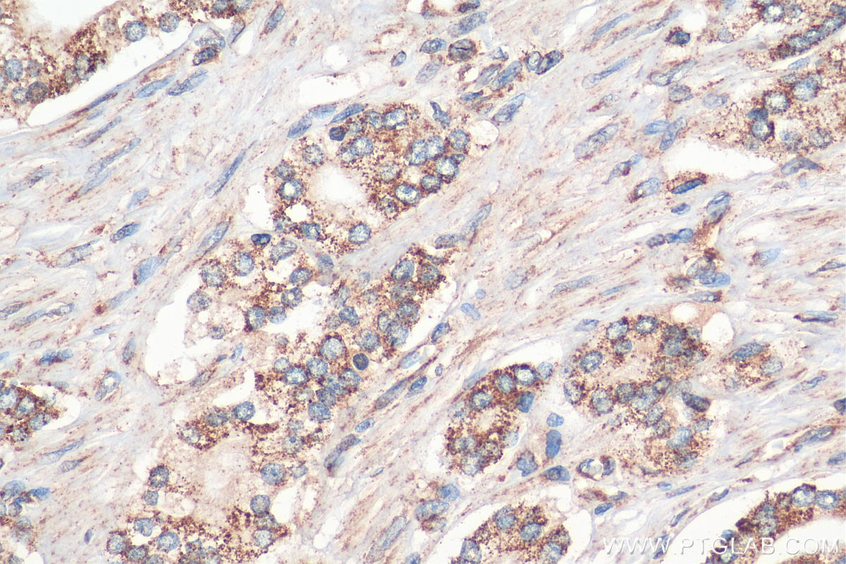 IHC staining of human prostate cancer using 13419-1-AP