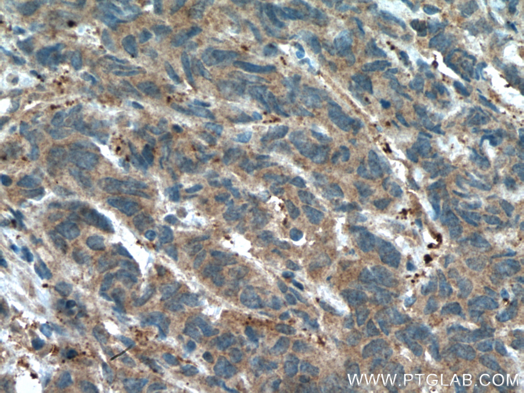 IHC staining of human prostate cancer using 11051-1-AP