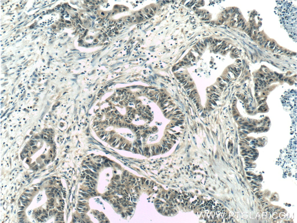 IHC staining of human pancreas cancer using 66193-1-Ig (same clone as 66193-1-PBS)