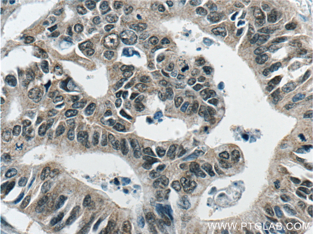 IHC staining of human pancreas cancer using 66193-1-Ig (same clone as 66193-1-PBS)