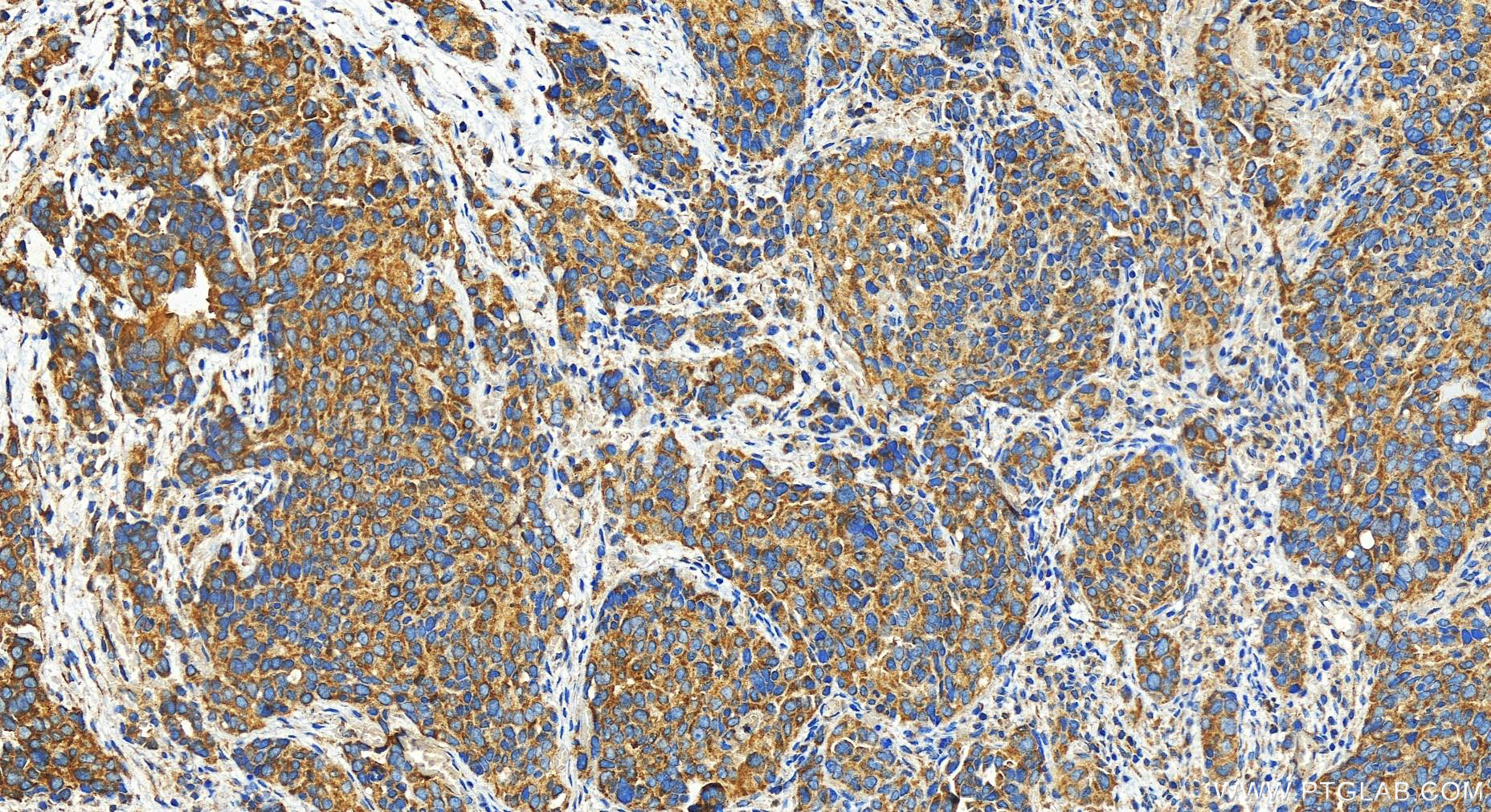 IHC staining of human ovary cancer using 28130-1-AP