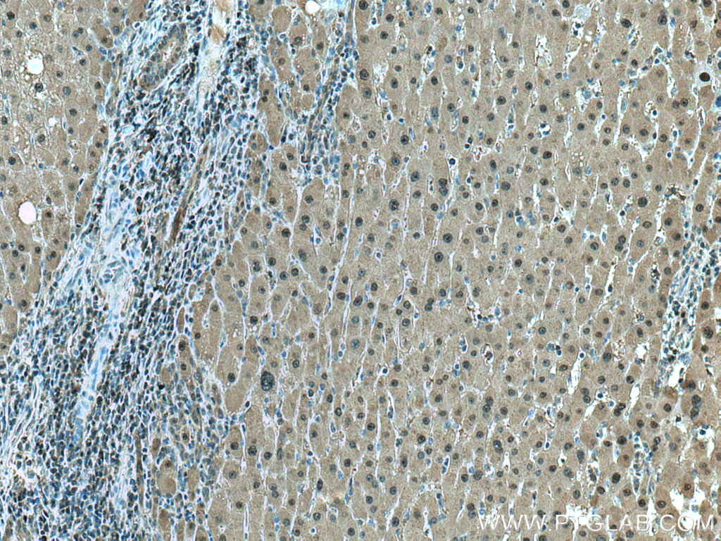 IHC staining of human liver cancer using 67598-1-Ig (same clone as 67598-1-PBS)