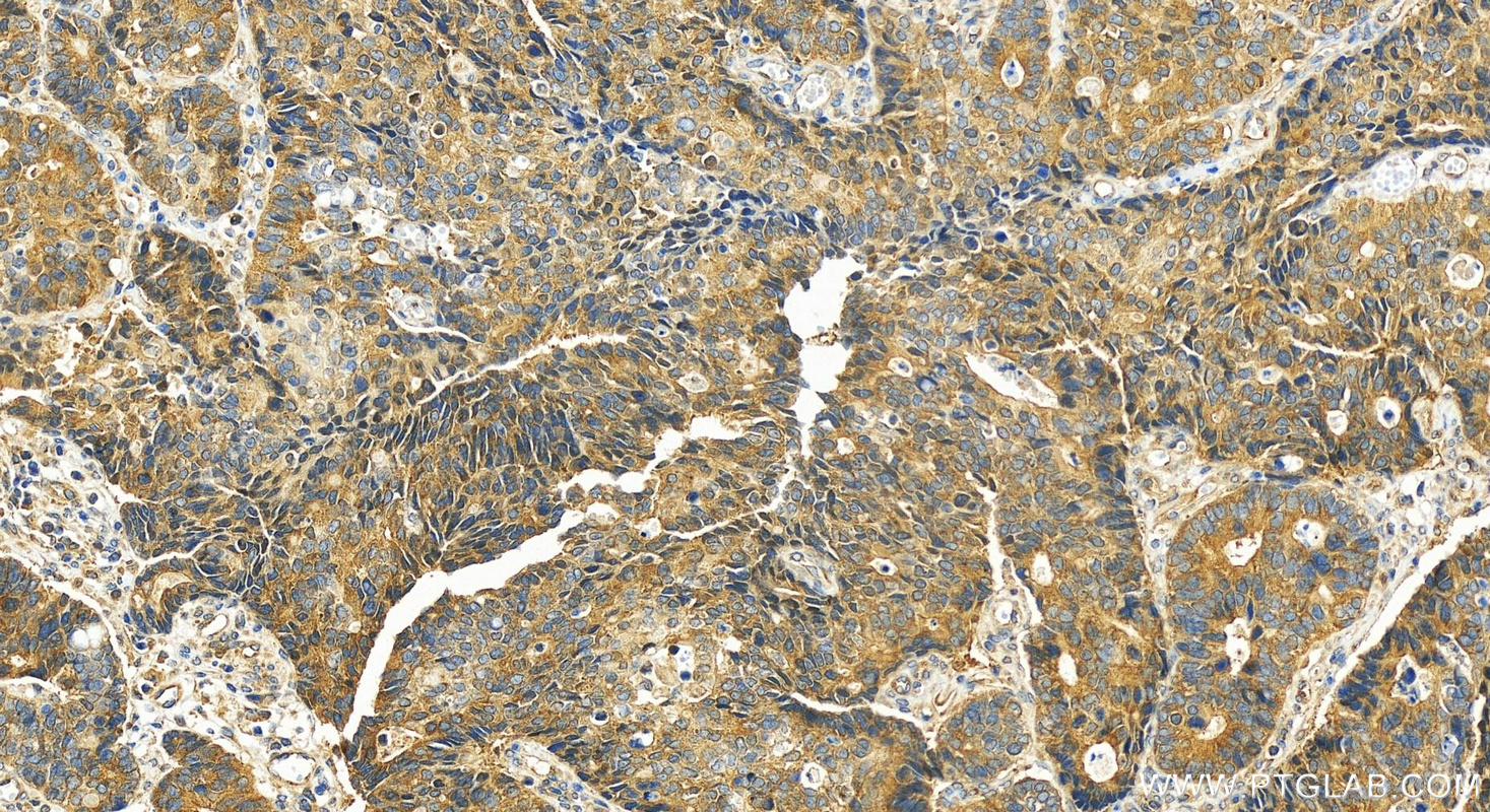 IHC staining of human stomach cancer using 55474-1-AP