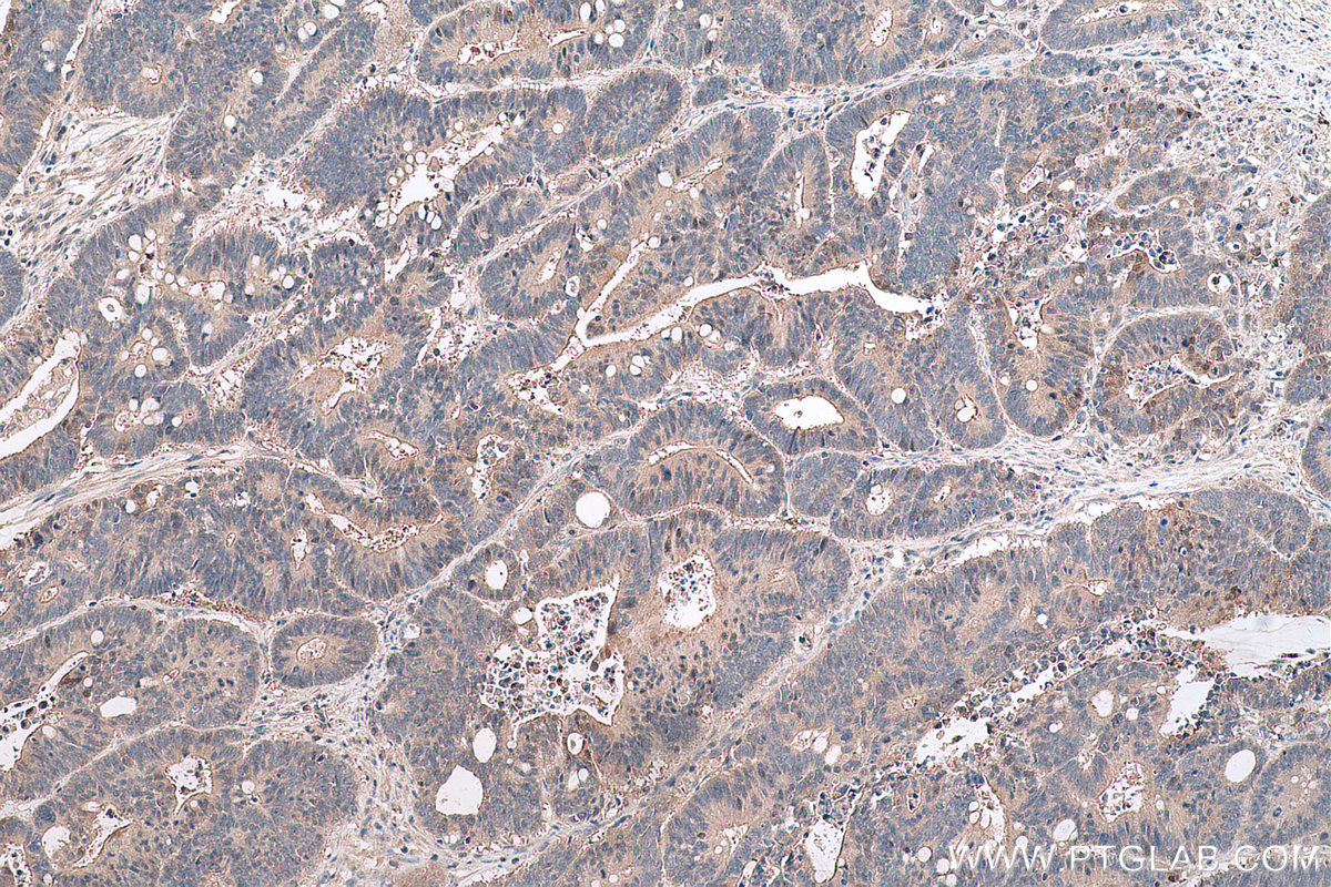 IHC staining of human colon cancer using 16766-1-AP