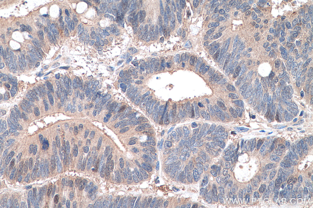 IHC staining of human colon cancer using 16766-1-AP