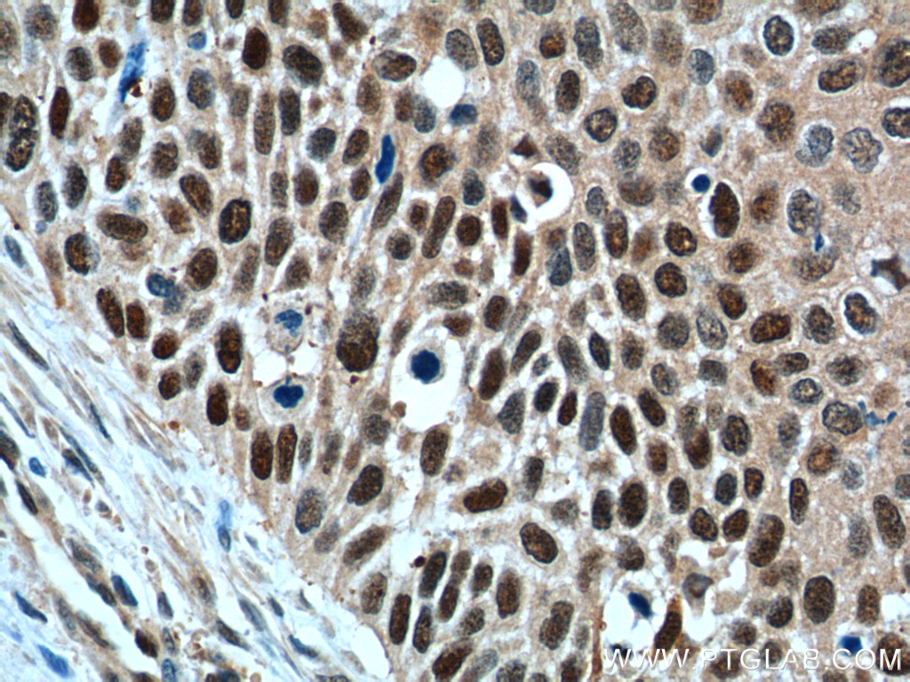 IHC staining of human oesophagus cancer using 60150-2-Ig (same clone as 60150-2-PBS)