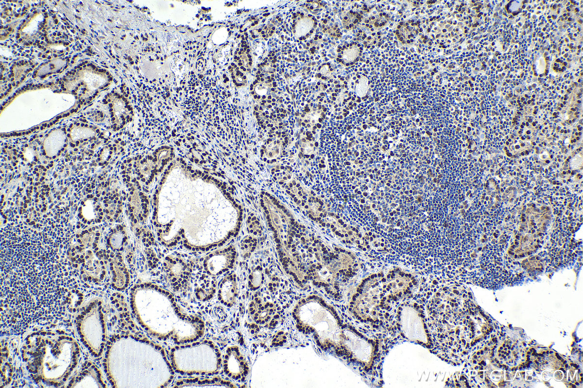 IHC staining of human thyroid cancer using 10499-1-AP