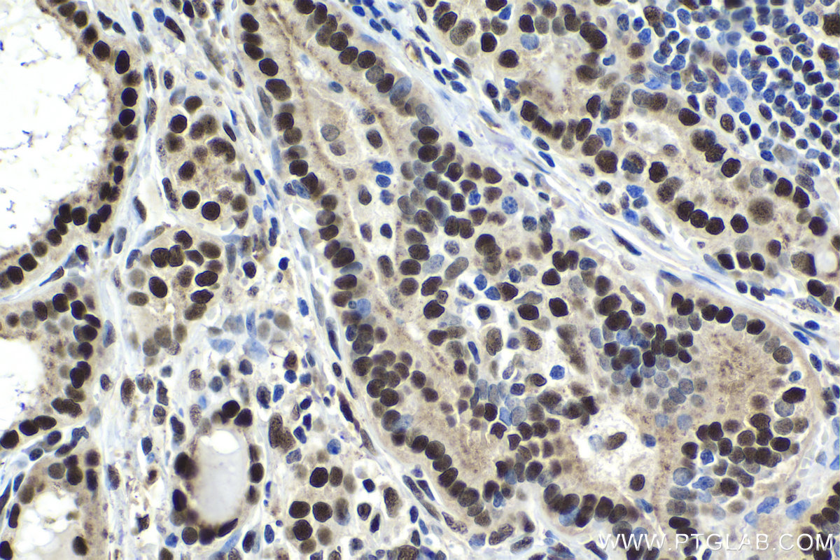 IHC staining of human thyroid cancer using 10499-1-AP