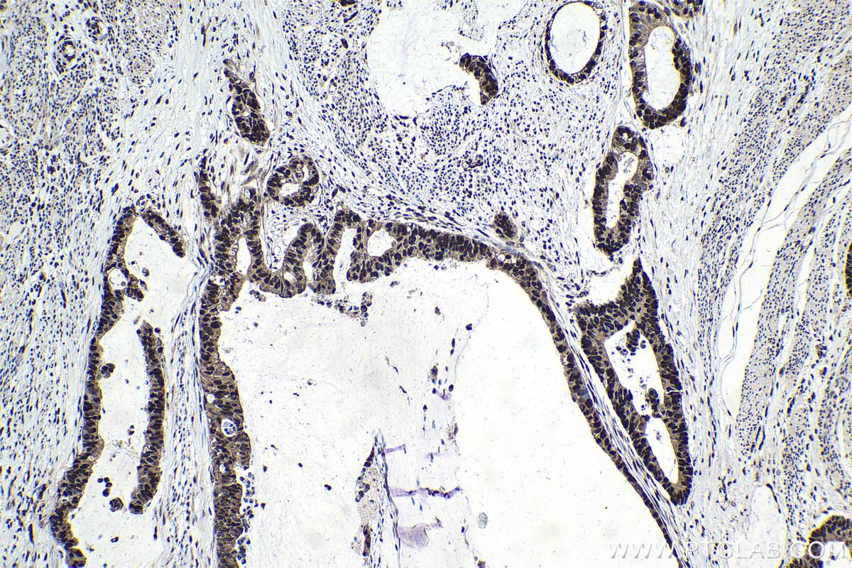 IHC staining of human urothelial carcinoma using 10499-1-AP