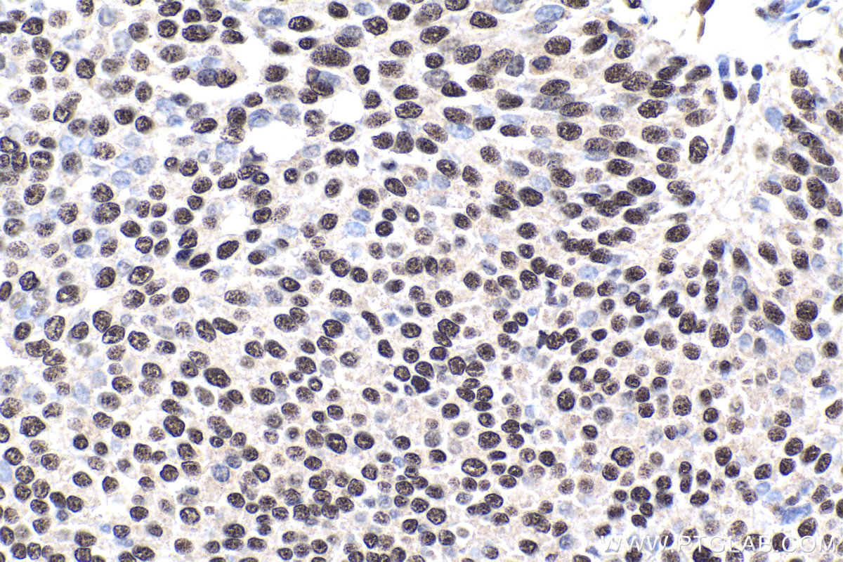 IHC staining of human urothelial carcinoma using 26382-1-AP