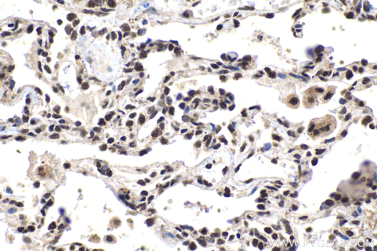 IHC staining of human lung cancer using 26382-1-AP