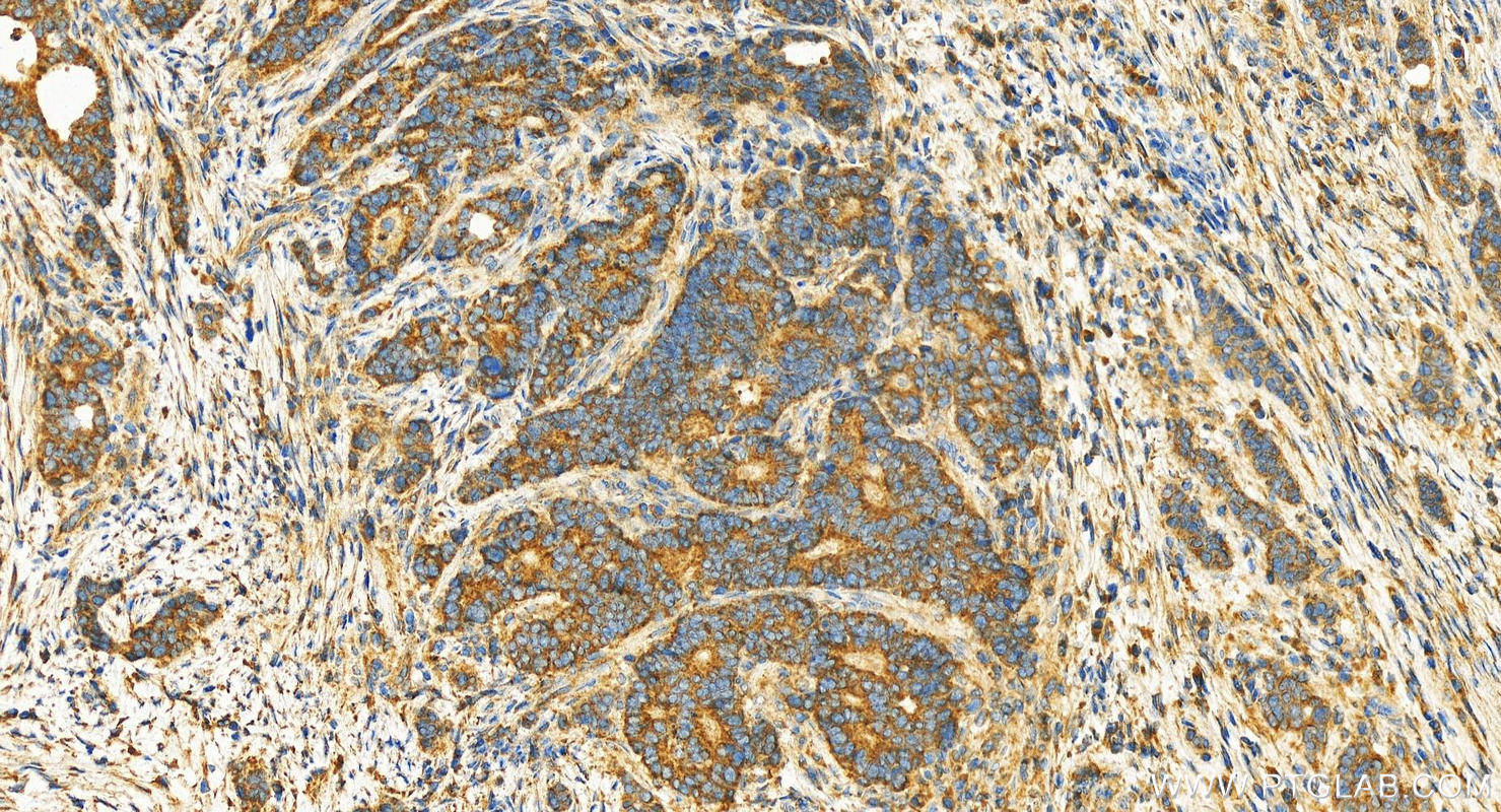 IHC staining of human stomach cancer using 19902-1-AP