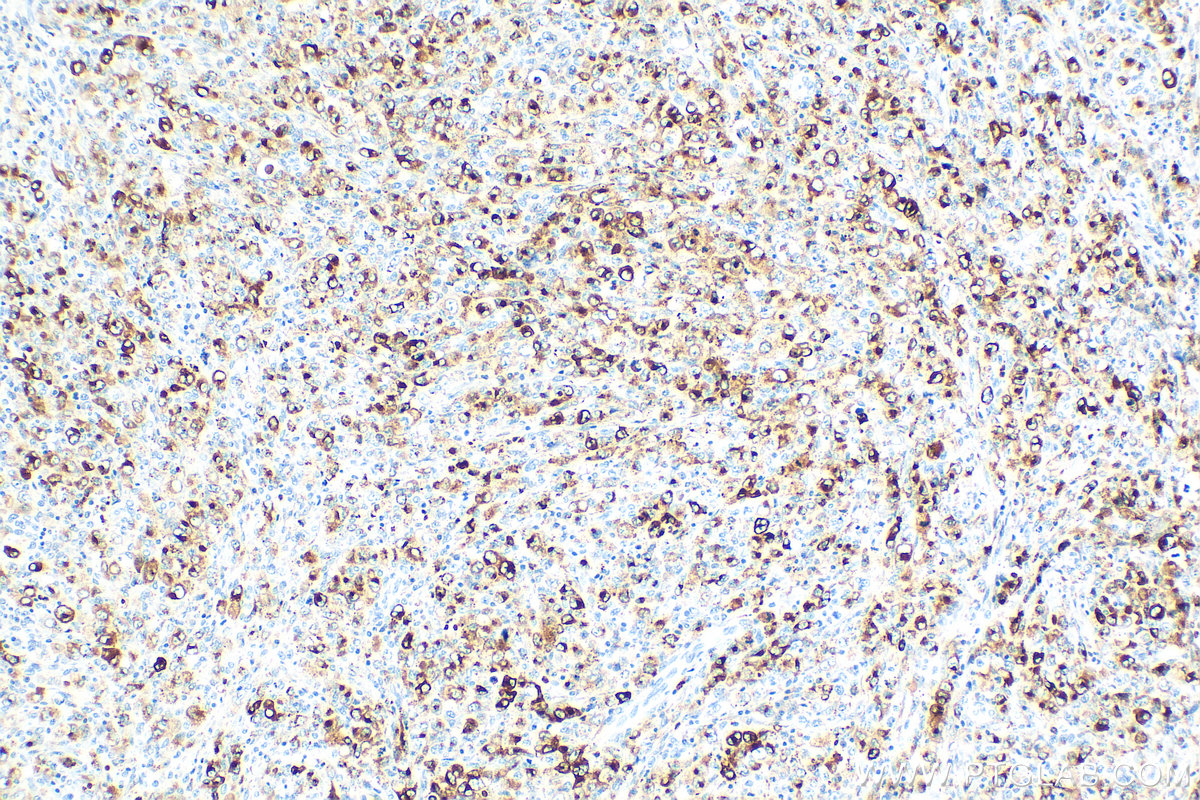 IHC staining of human lymphoma using 31521-1-AP