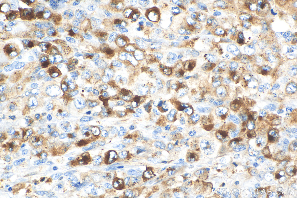 IHC staining of human lymphoma using 31521-1-AP