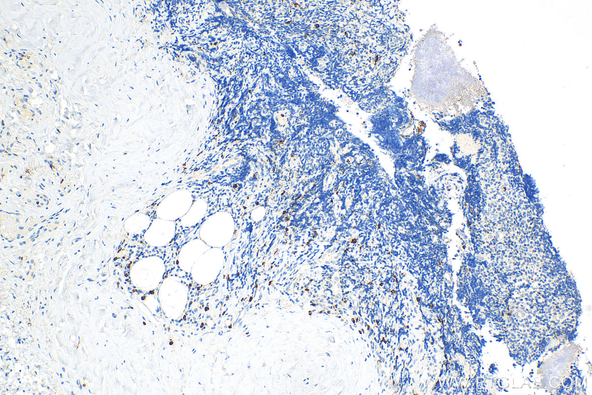 IHC staining of human tonsillitis using 31521-1-AP