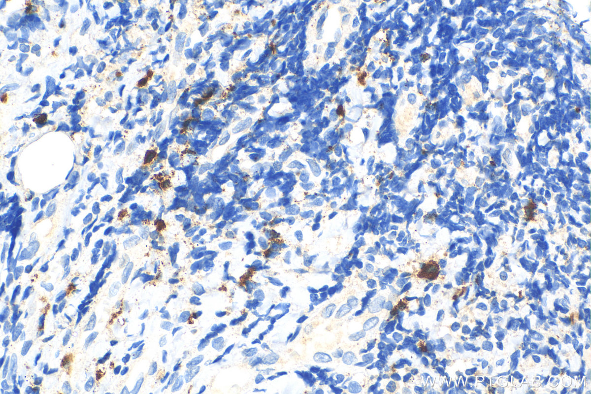 IHC staining of human tonsillitis using 31521-1-AP