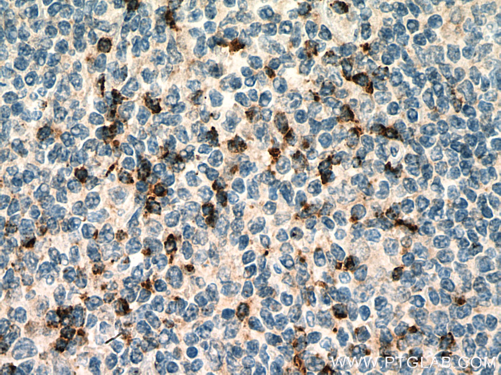 IHC staining of human tonsillitis using 67272-1-Ig (same clone as 67272-1-PBS)