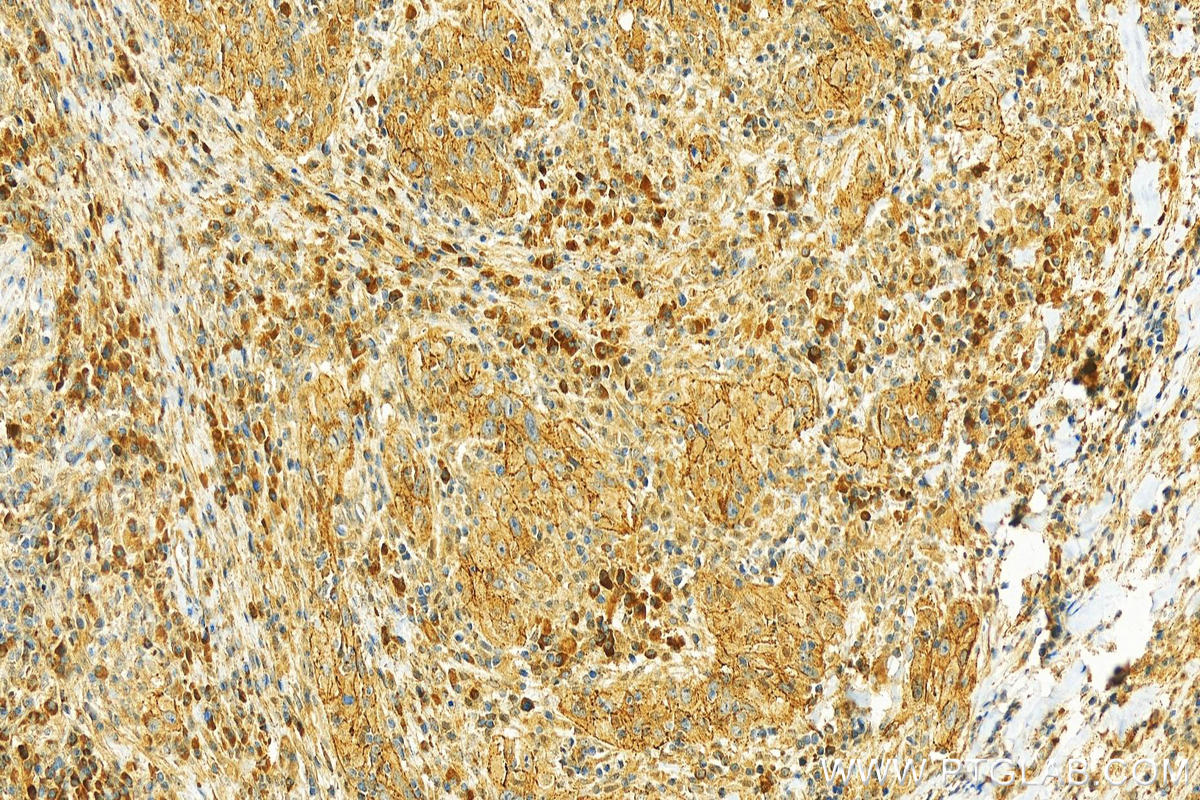 IHC staining of human skin cancer using 25948-1-AP