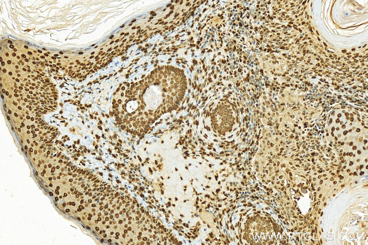 IHC staining of human skin cancer using 17510-1-AP