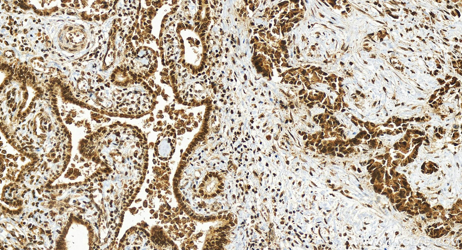 IHC staining of human intrahepatic cholangiocarcinoma using 26875-1-AP