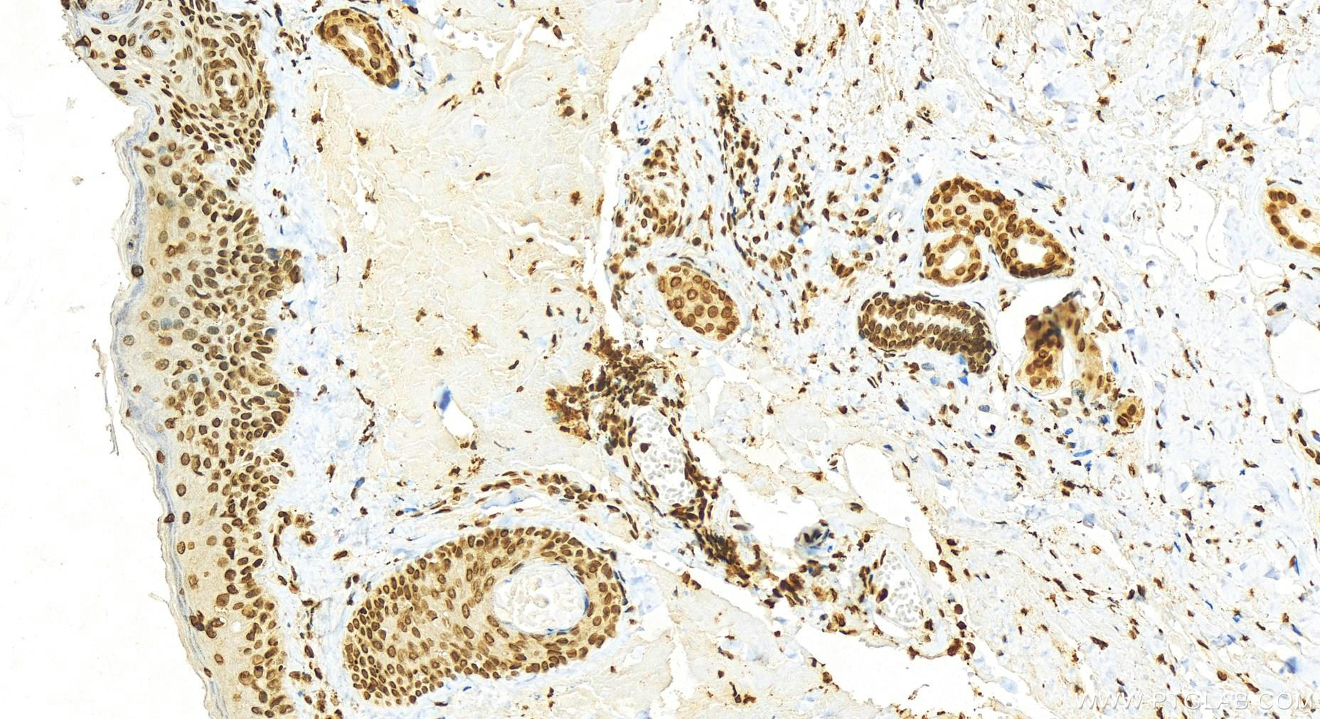 IHC staining of human skin cancer using 16441-1-AP