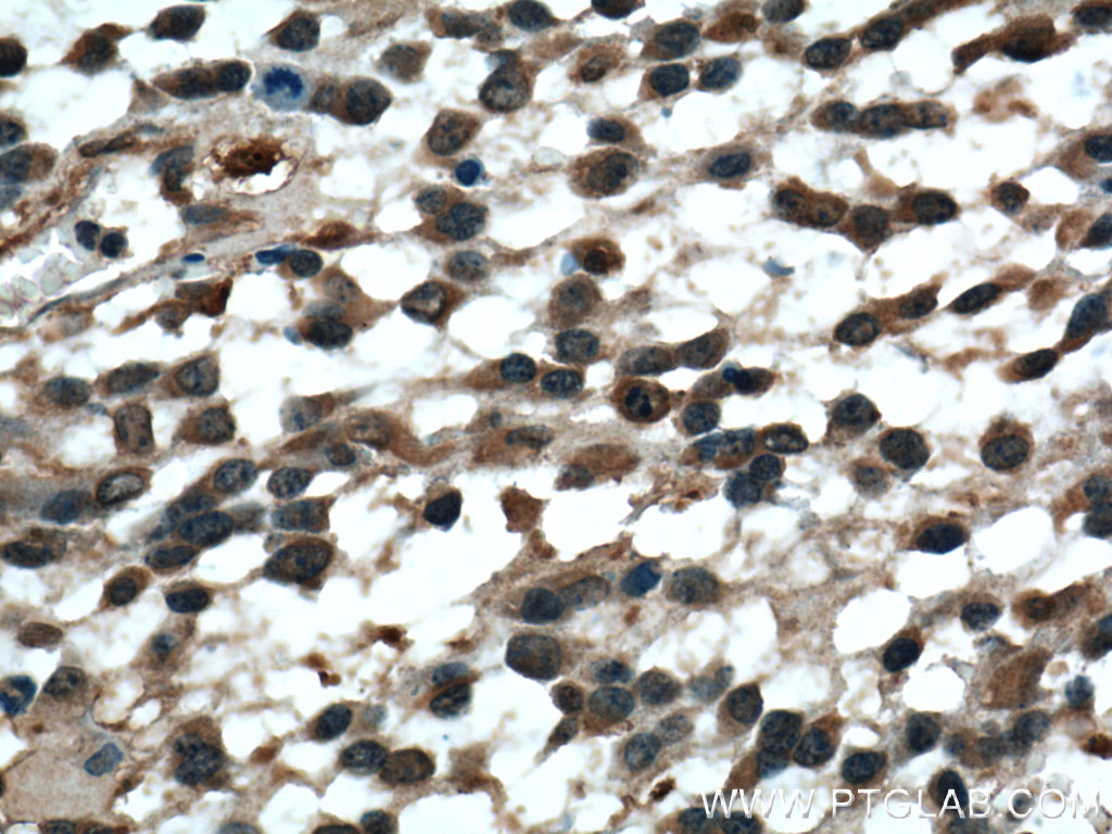 IHC staining of human gliomas using 12791-1-AP