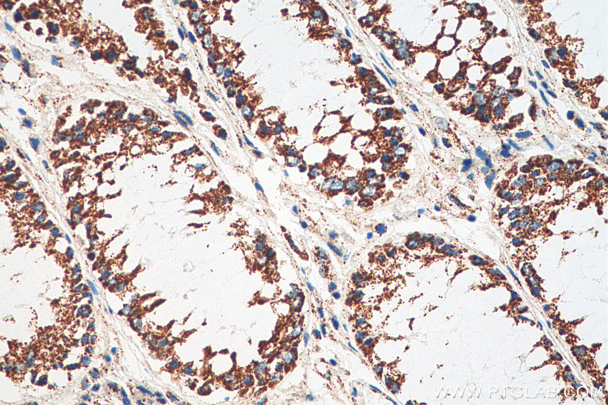IHC staining of human colon cancer using 67967-1-Ig (same clone as 67967-1-PBS)