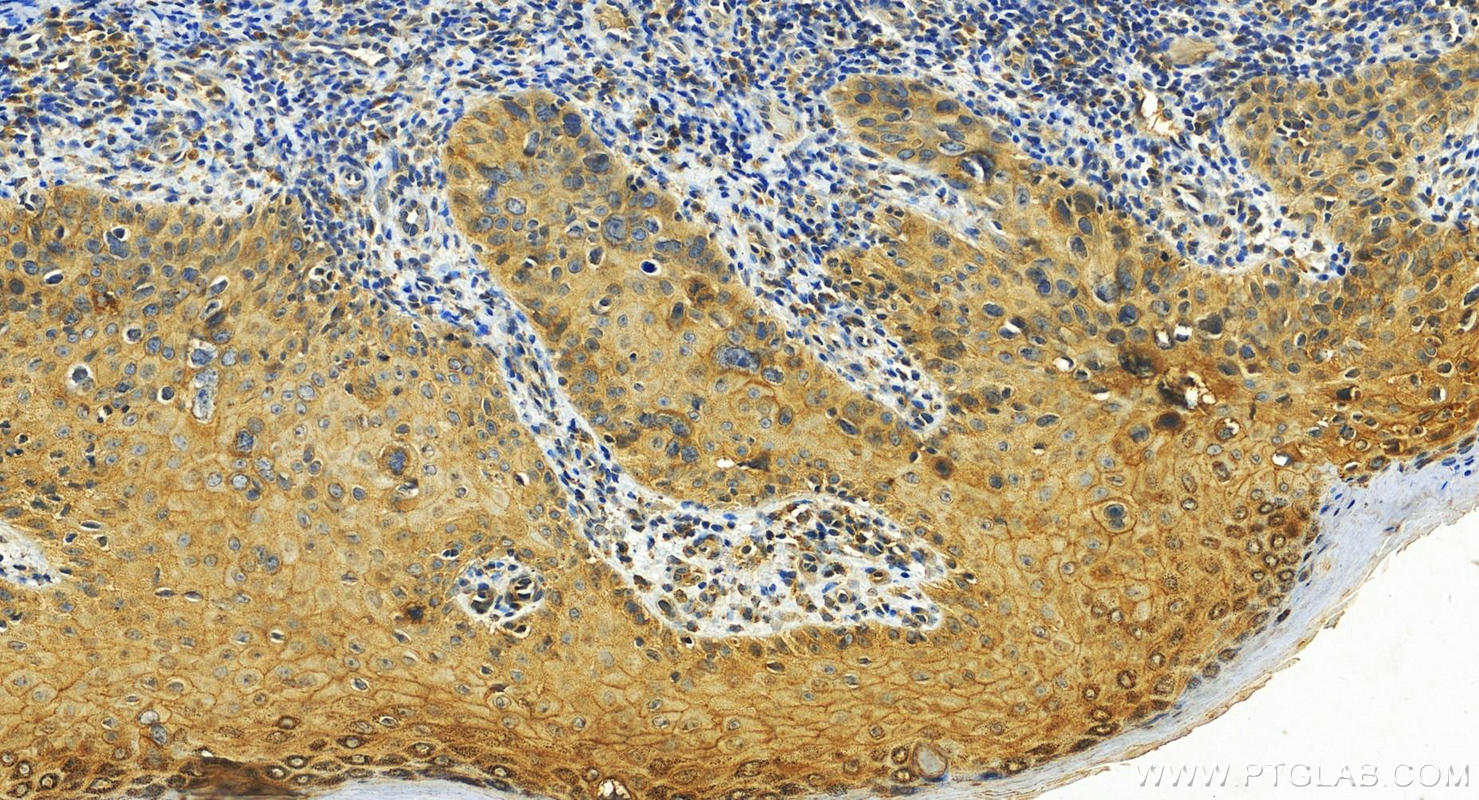 IHC staining of human brown disease using 27593-1-AP